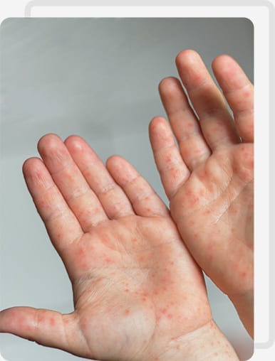 Hand Foot & Mouth Disease (HFMD) - Medklinn